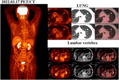 QL1604 combined with bevacizumab as an innovative first-line treatment for HCC patient with extensive metastasis who showed remarkable effect: a case report